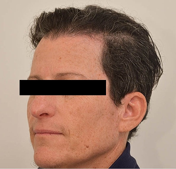 Hair Transplant Before & After