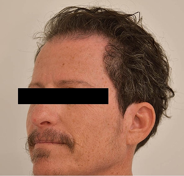 Hair Transplant Before & After