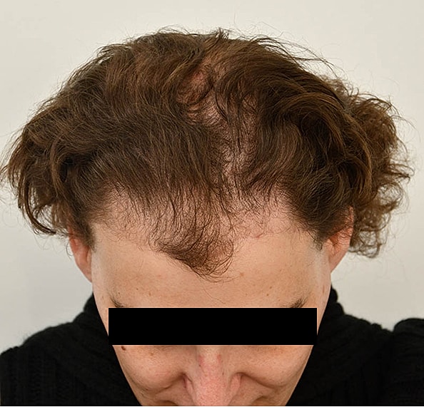 Hair Transplant Before & After