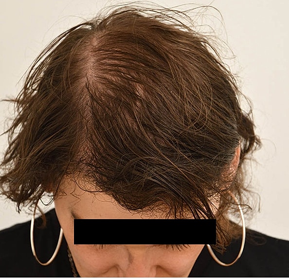 Hair Transplant Before & After
