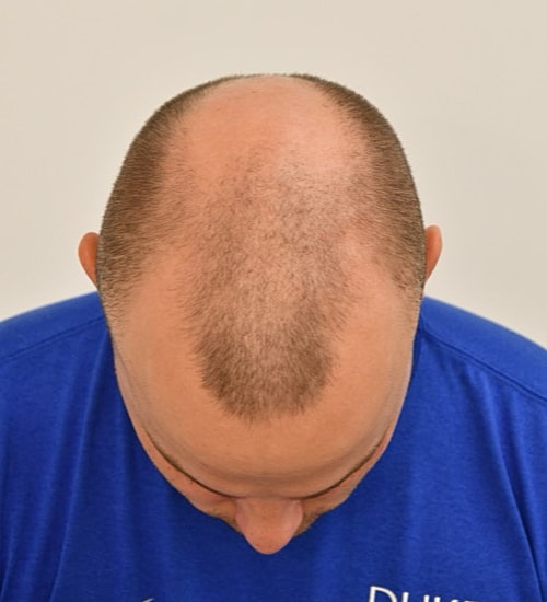 Balding man looking down at his scalp.