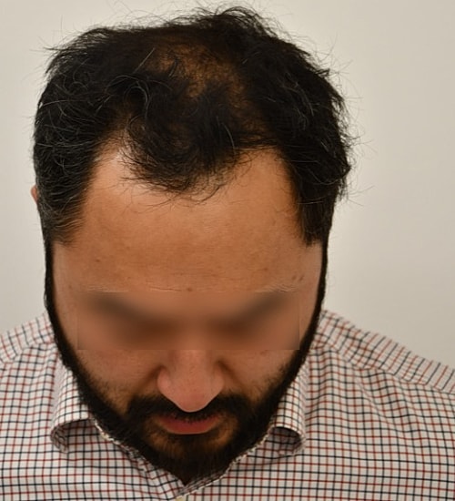 Man with thinning hair looking downwards.