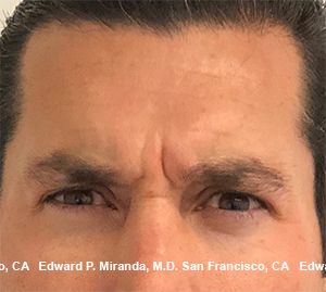 Neurotoxins Before & After
