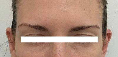 Neurotoxins Before & After