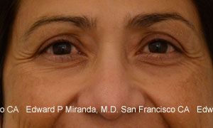 Neurotoxins Before & After