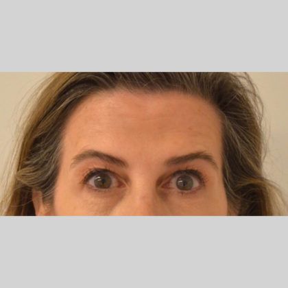 Neurotoxins Before & After