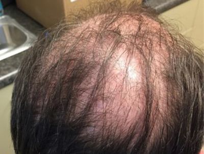 Prp For Hair Loss Before & After
