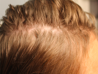 Prp For Hair Loss Before & After