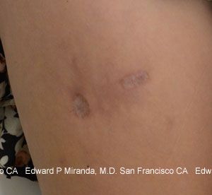 Scar Revision Before & After