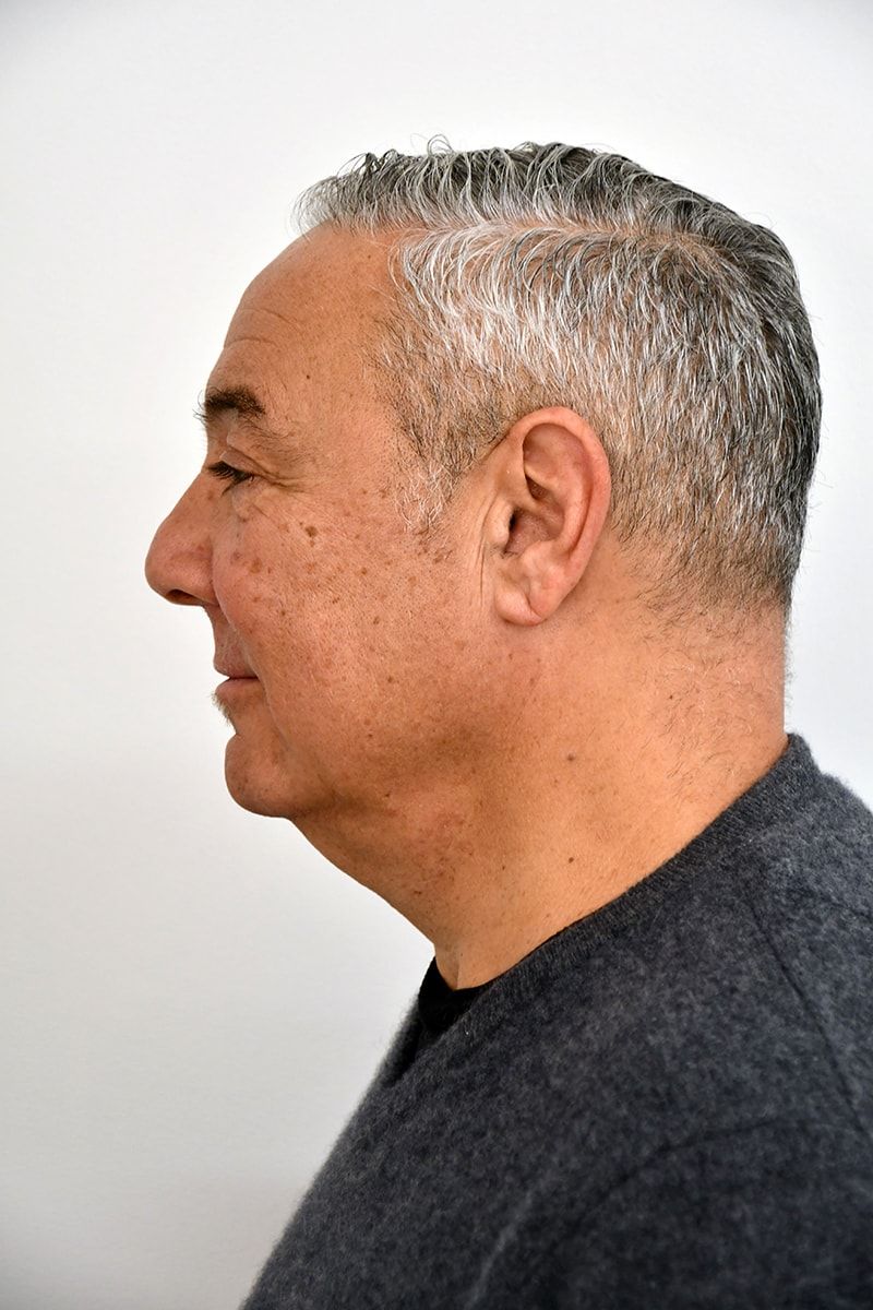 Fat Grafting Before & After