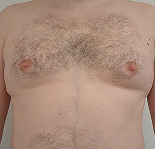 Gynecomastia Before & After