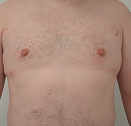 Gynecomastia Before & After