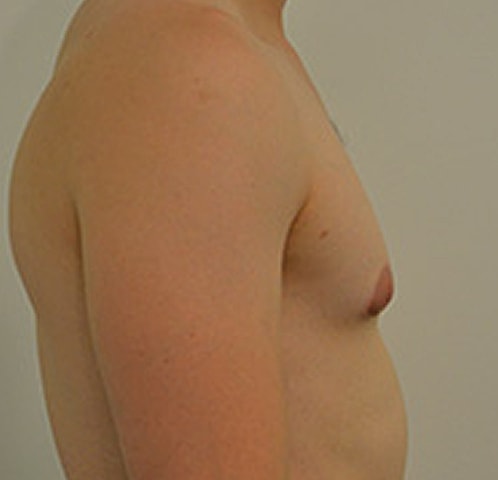 Gynecomastia Before & After