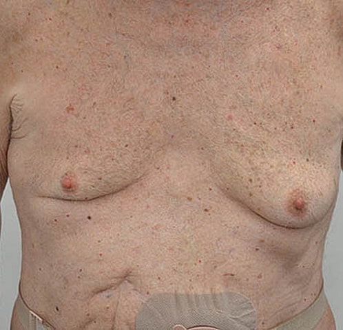 Gynecomastia Before & After