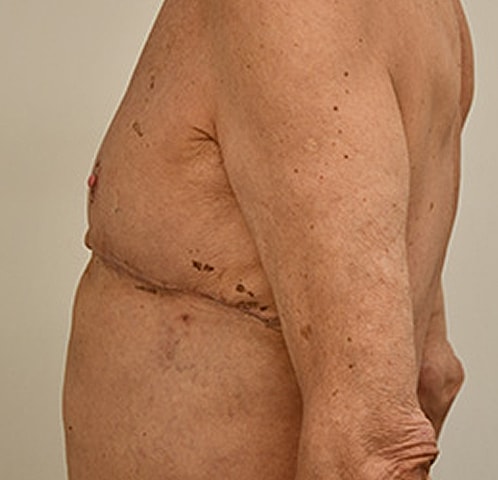 Gynecomastia Before & After