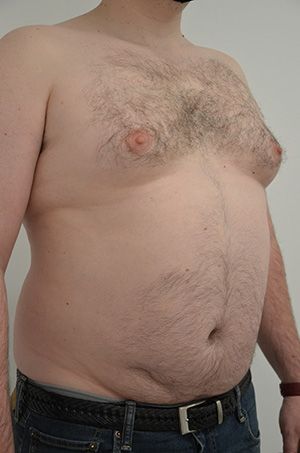 Gynecomastia Before & After