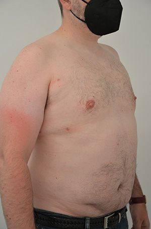 Gynecomastia Before & After