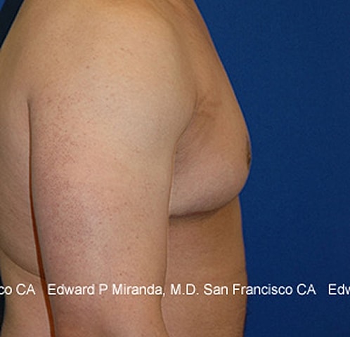 Gynecomastia Before & After