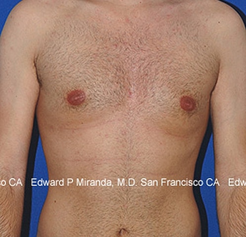 Gynecomastia Before & After