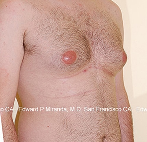 Gynecomastia Before & After