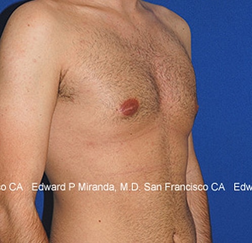 Gynecomastia Before & After