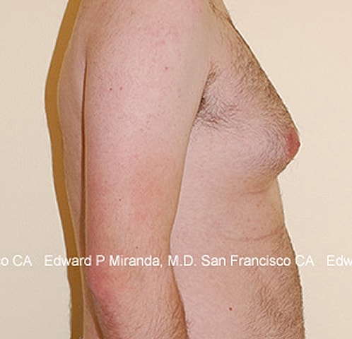 Gynecomastia Before & After