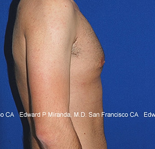 Gynecomastia Before & After