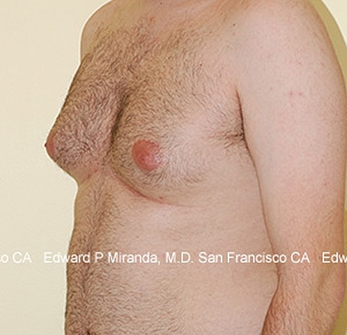 Gynecomastia Before & After