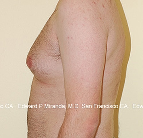 Gynecomastia Before & After