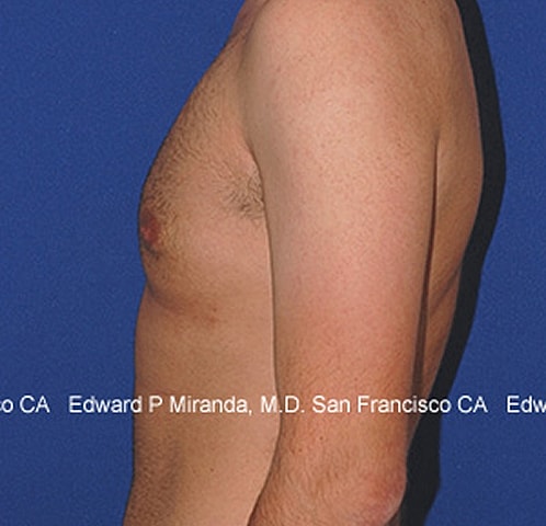 Gynecomastia Before & After