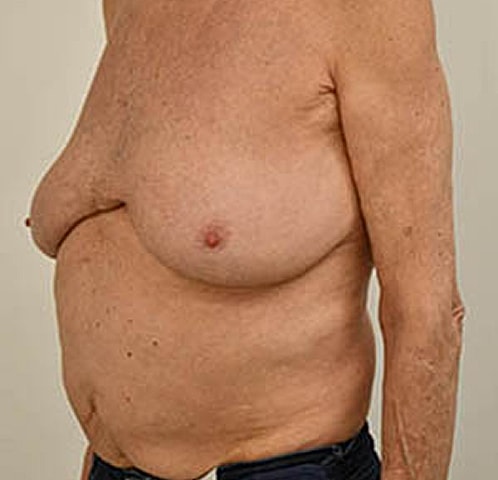 Gynecomastia Before & After