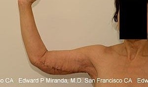 Arm Lift Before & After