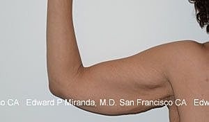 Arm Lift Before & After