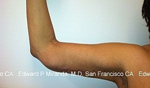 Arm Lift Before & After