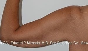 Arm Lift Before & After