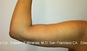 Arm Lift Before & After