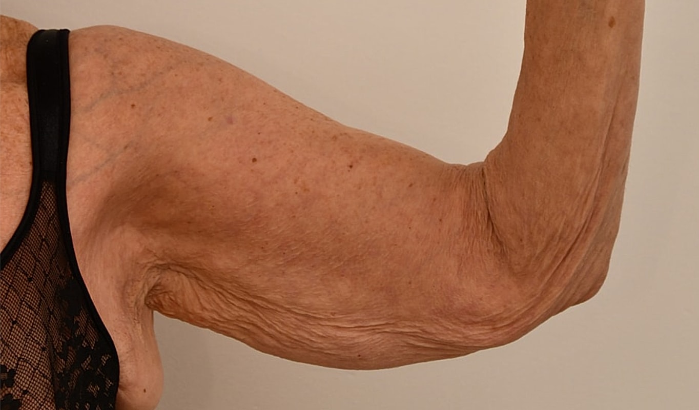 Arm Lift Before & After
