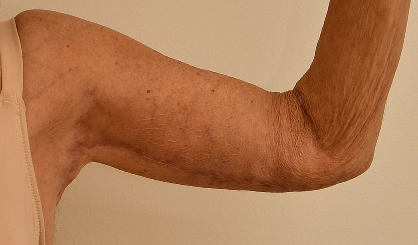 Arm Lift Before & After