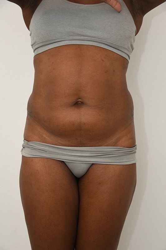 Gender Affirming Body Contouring Before & After