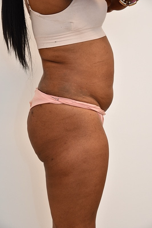 Gender Affirming Body Contouring Before & After