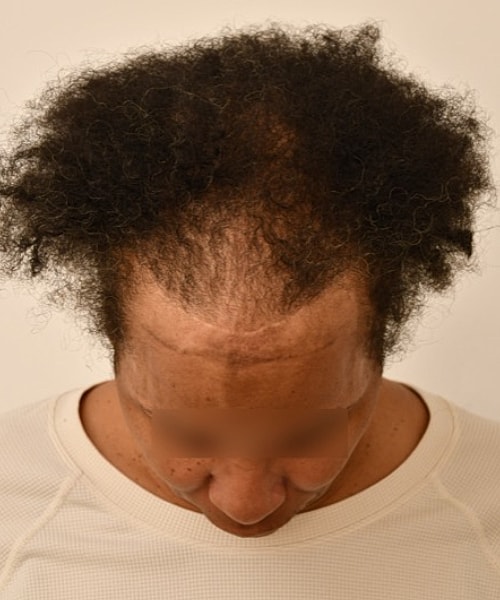 Person showing thinning hair from above.