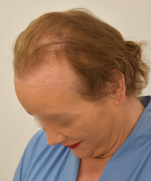 Woman with thinning hair looking downwards.