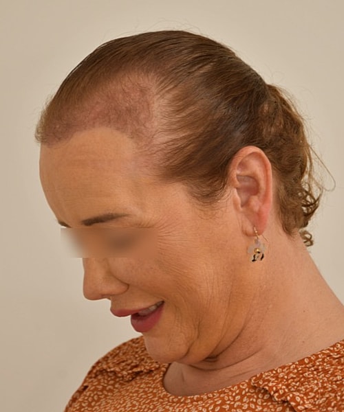 Person with thinning hair and warm smile.