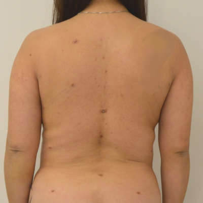 Liposuction Before & After