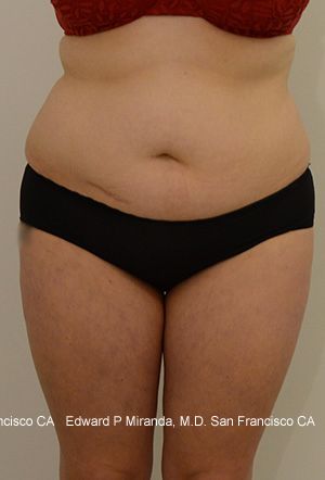 Liposuction Before & After