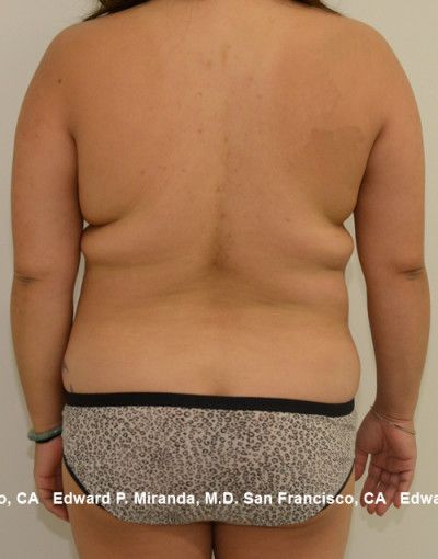 Liposuction Before & After