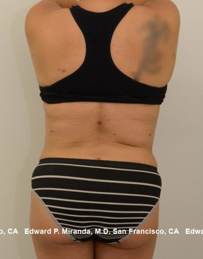 Liposuction Before & After