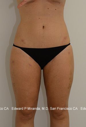 Liposuction Before & After