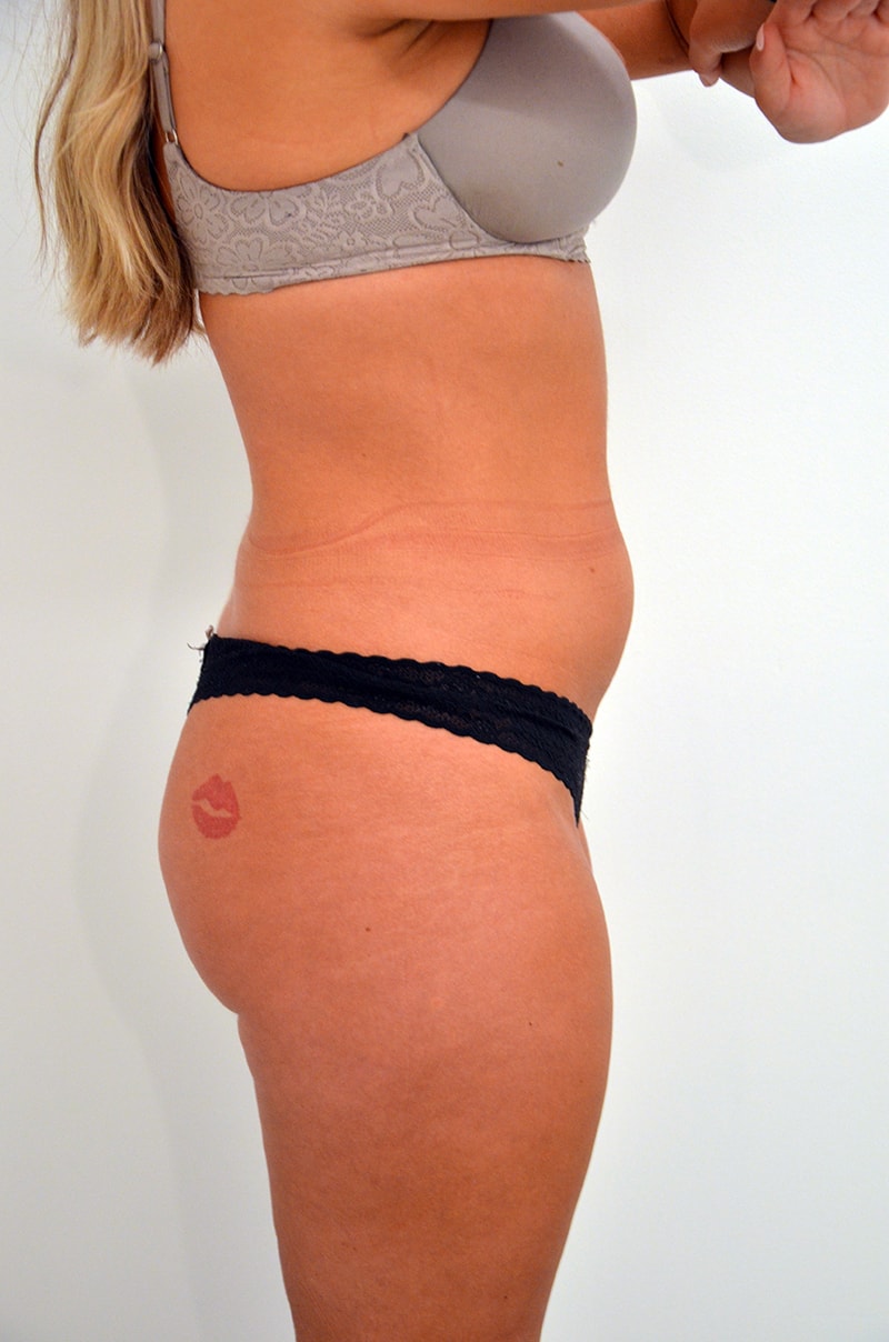 Liposuction Before & After Image