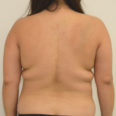 Liposuction Before & After Image